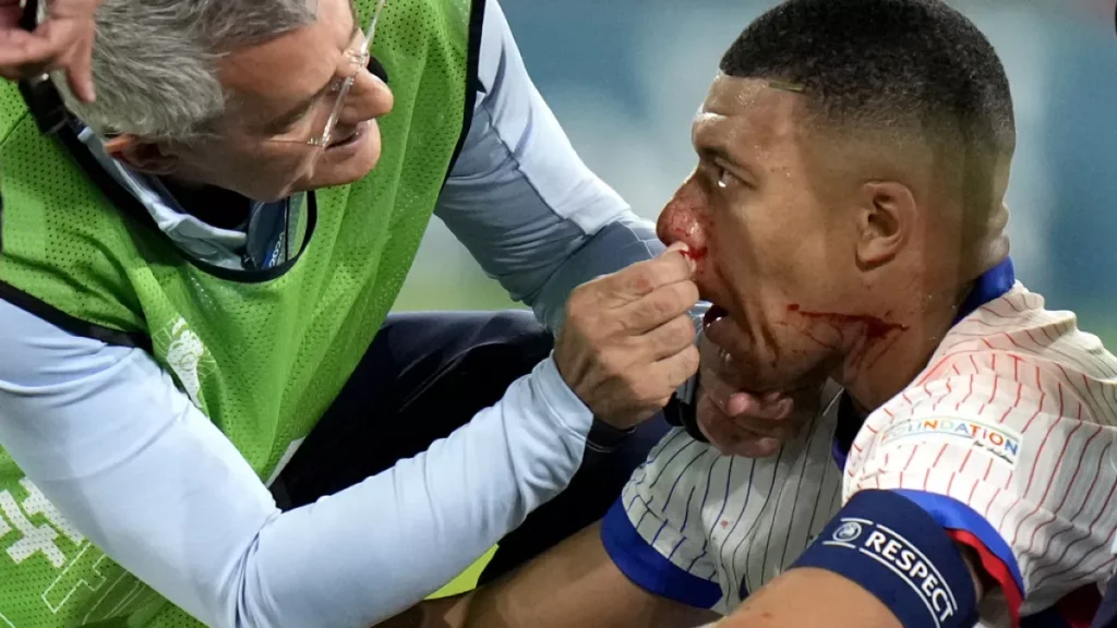 Mbappe nariz rota