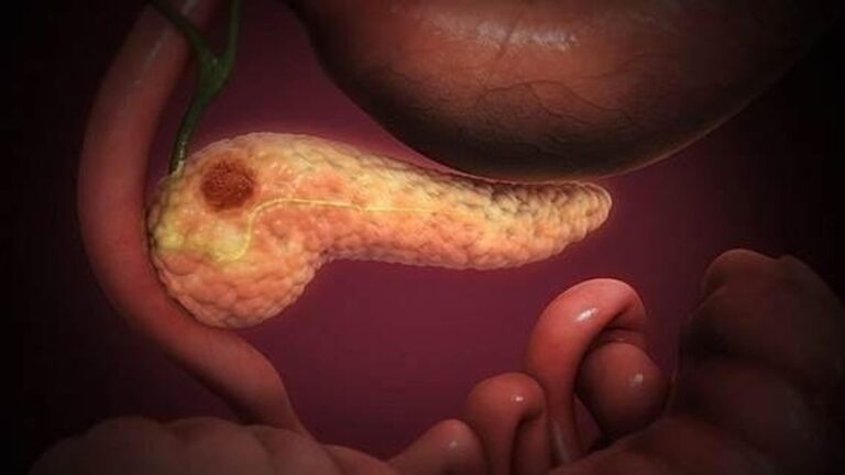 cancer de pancrea