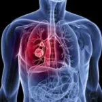 cancer de pulmon