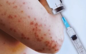 Alarma a dominicanos en NYC aparición del sarampión