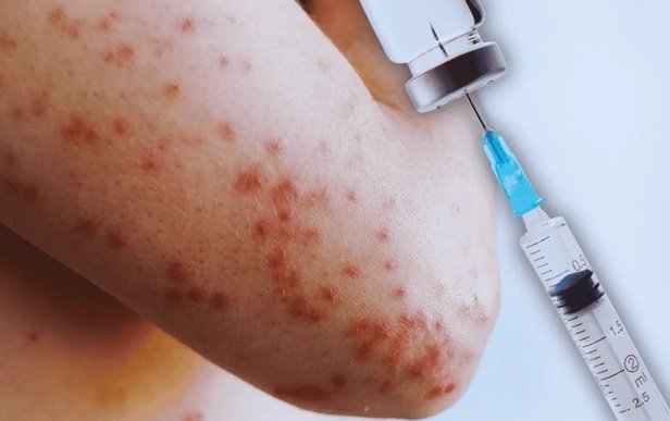 Alarma a dominicanos en NYC aparición del sarampión