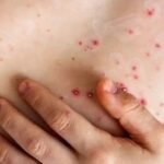 NYC reporta el primer caso de Mpox