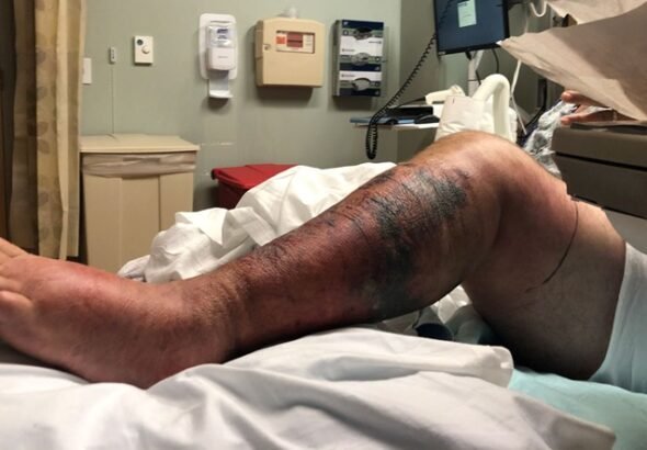 Encuentran bacteria carnívora en aguas Long Island pueden matar personas en 48 horas