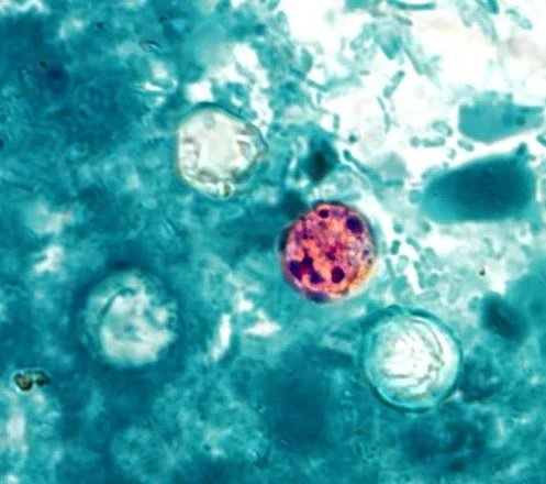 Parásito ciclosporiasis causa grave diarrea aumenta en NYC y otros estados; dominicanos en alerta